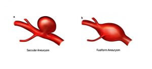 aneurysm-shapes